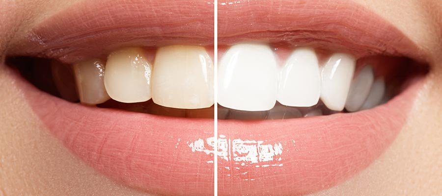 Teeth Whitening Dental Clinic in Istanbul Turkey