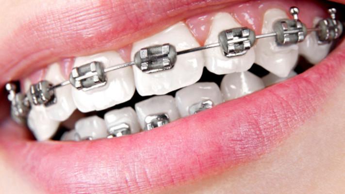 Orthodontic Treatment Braces Options