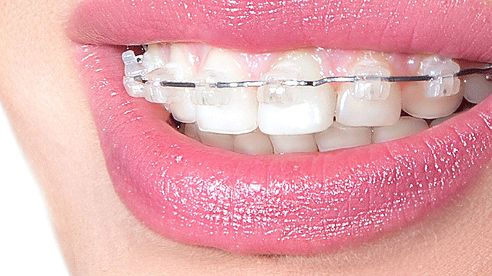Orthodontic Treatment with Transparent Plaques