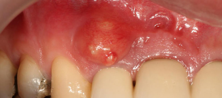 What Is A Jaw Cyst Operation Dent Avrasya Dental Clinic In Turkey 9628