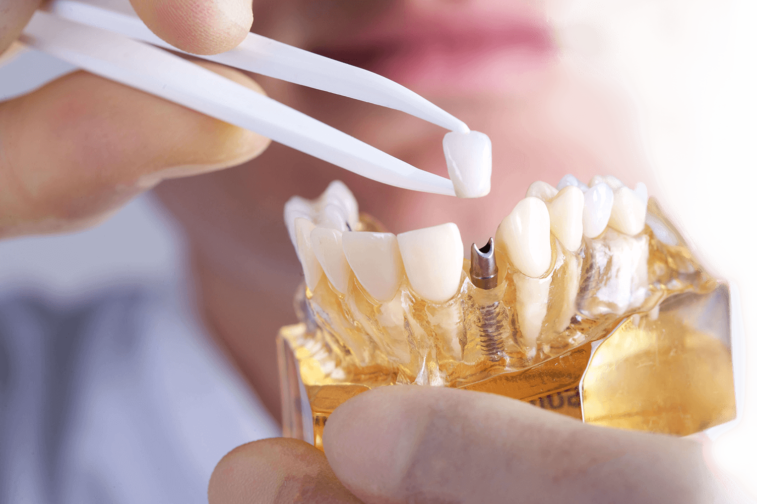 Dental implant in turkey