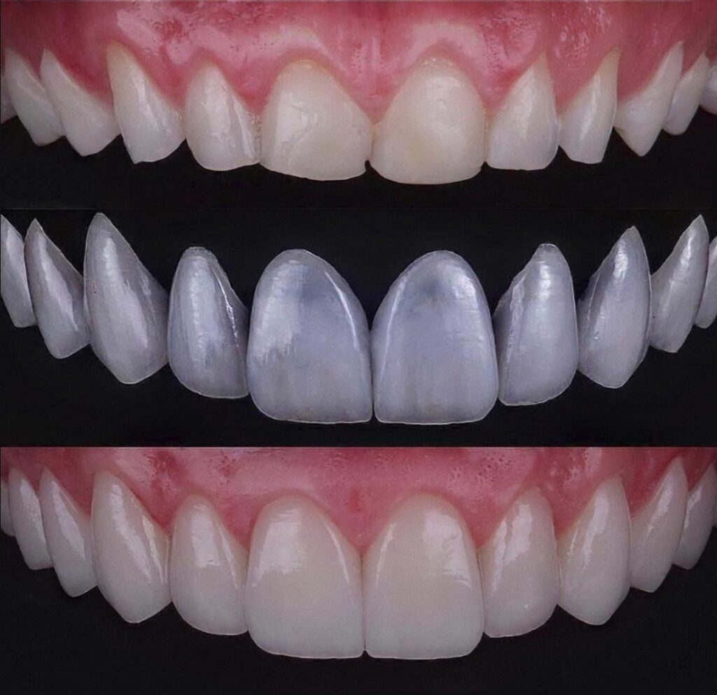 Emax Veneers in Turkey can be completed in 5 days