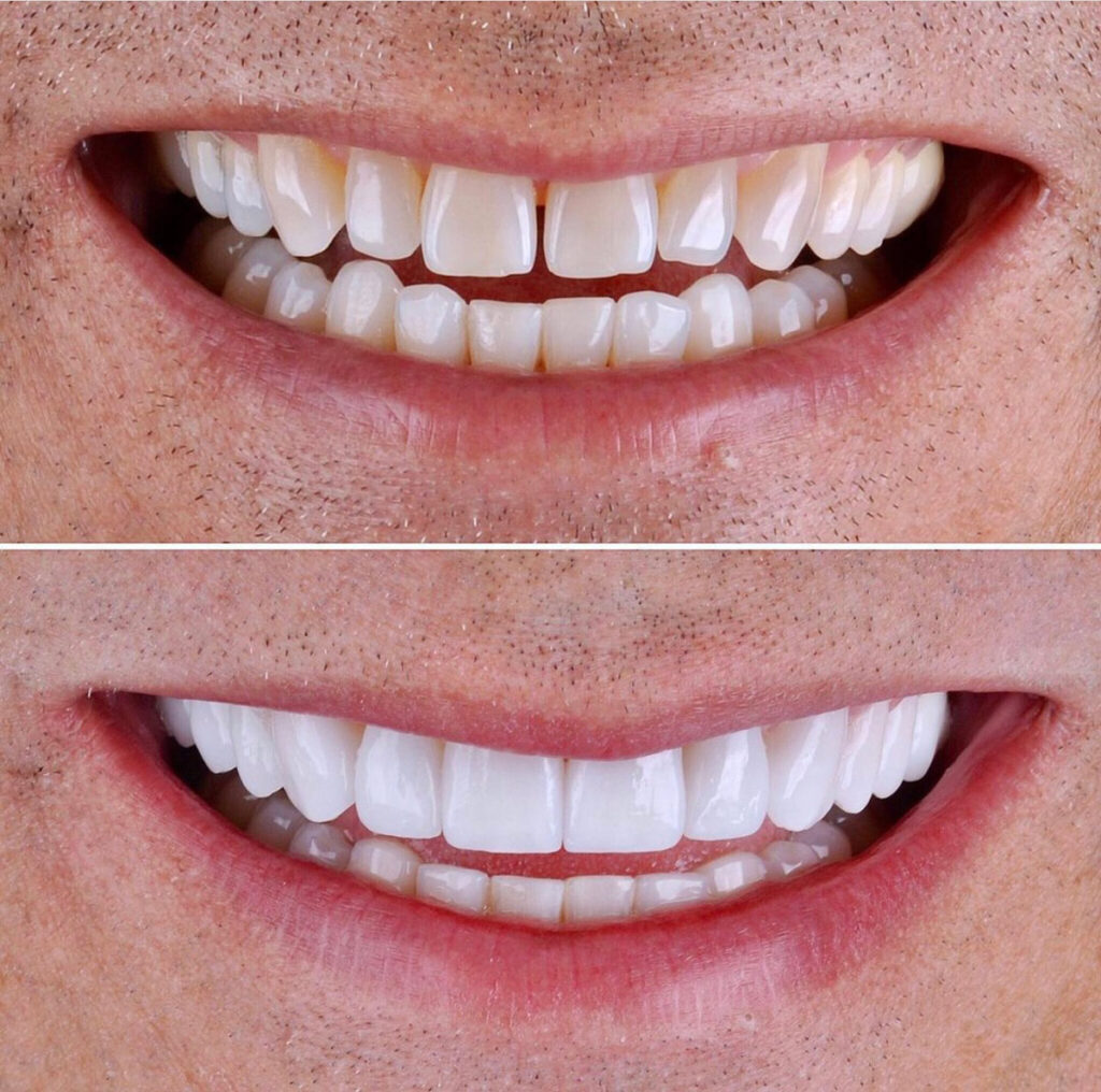 Veneers Zirconia at Suzie Brown blog