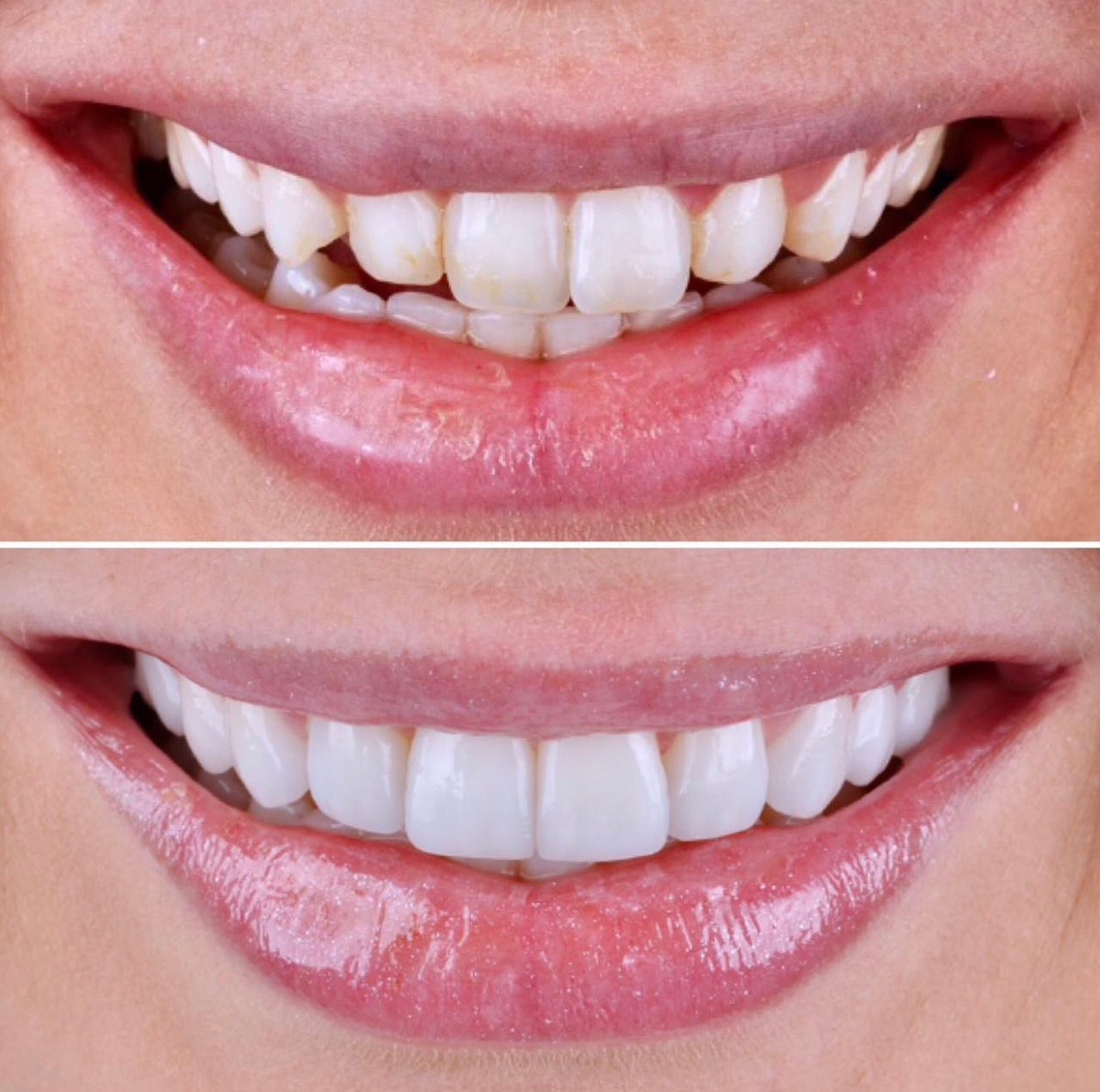 Zirconia Crown Costs Turkey Zirconium Veneers Turkey Emax Veneers