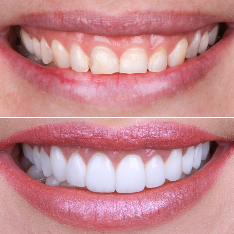 Emax Veneers in Turkey can be completed in 5 days