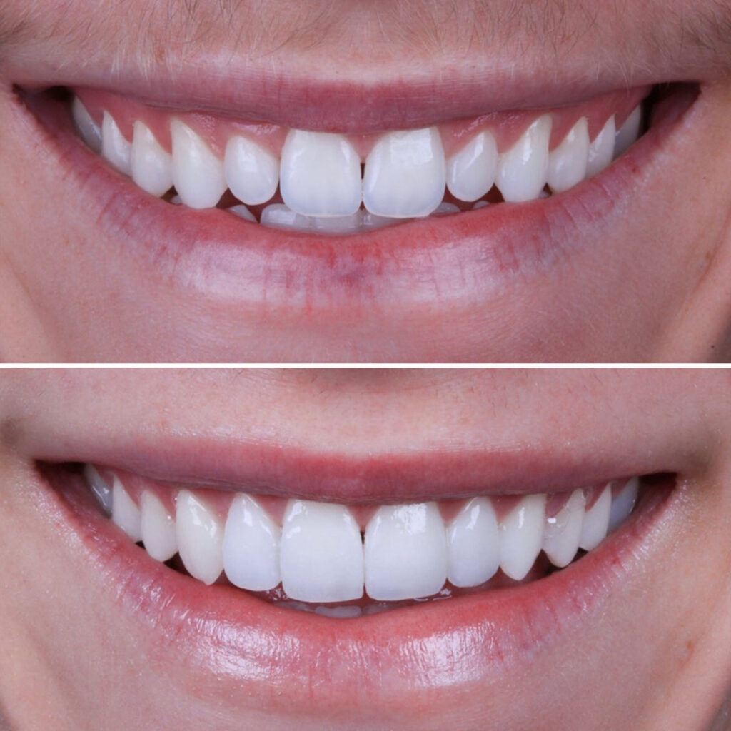 Emax Veneers in Turkey can be completed in 5 days