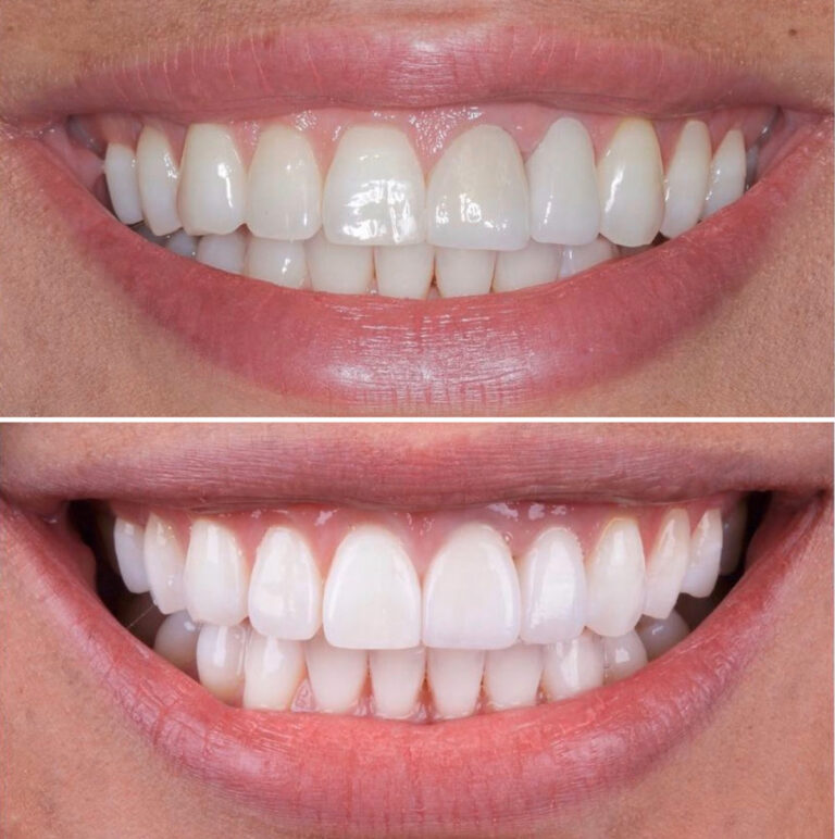 Emax Veneers in Turkey can be completed in 5 days