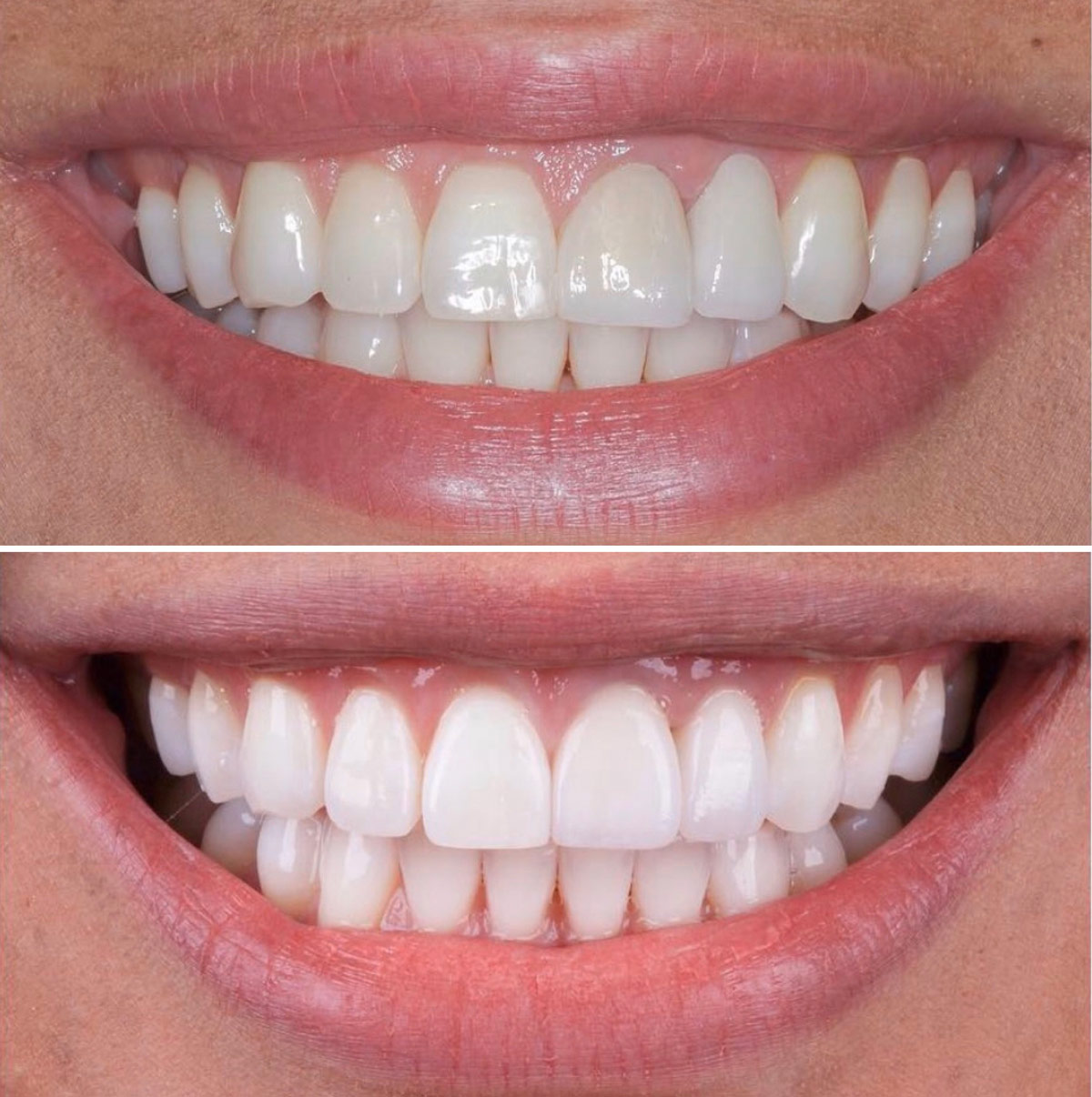 Emax Veneers In Turkey Can Be Completed In 5 Days